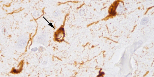 Abnormal accumulation of tau protein in neuronal cell bodies (arrow) and neuronal extensions (arrowhead) in the brain of a patient who had died with Alzheimer's disease.